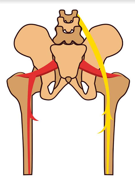 sciatica