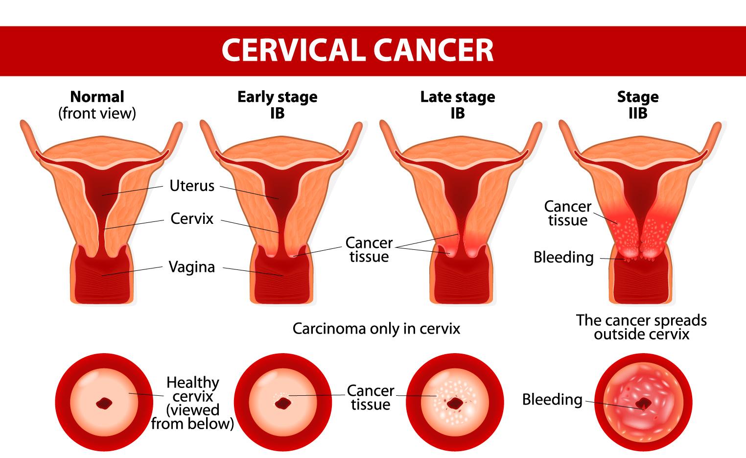 புற்றுநோயின் நிலைகள்