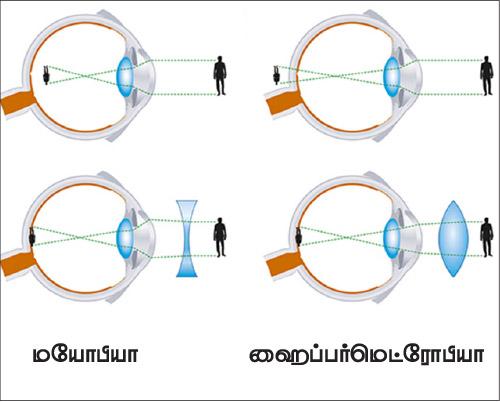 பார்வை கோளாறு