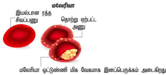 மலேரியா