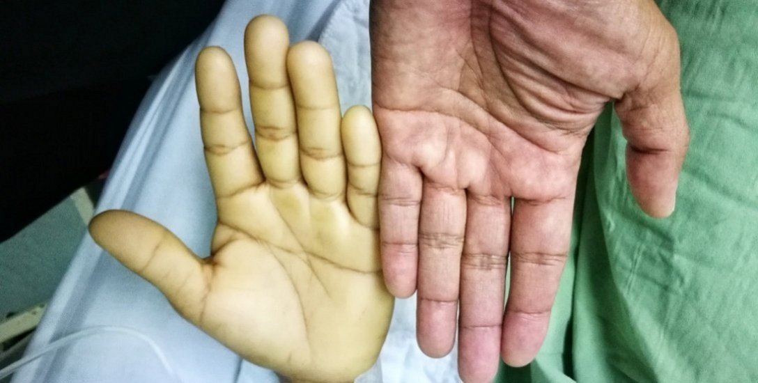 இரண்டில் ஒரு பெண்ணைப் பாதிக்கும் அனீமியா...  தப்பிப்பது எப்படி? #Anemia